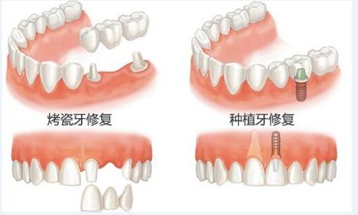 贵阳种植牙