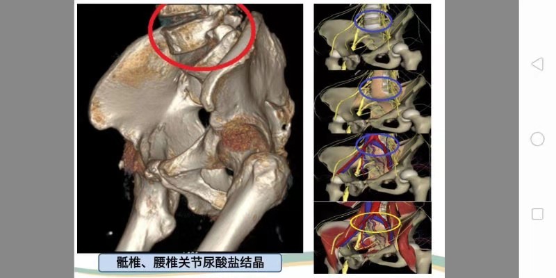 痛风案例