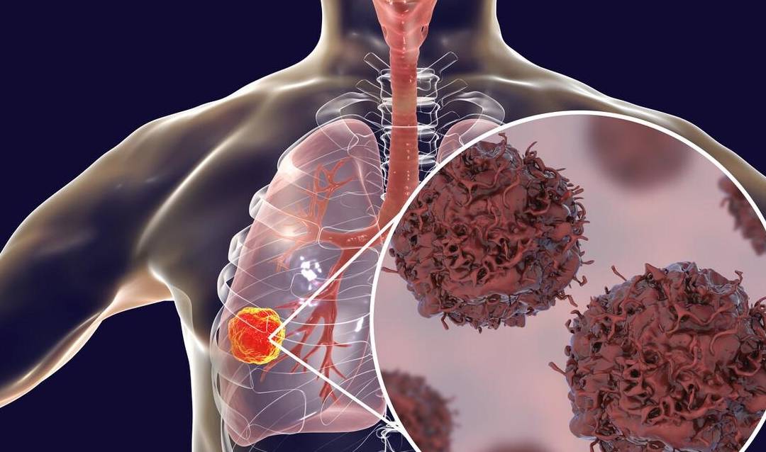贵阳治疗癌症的中医